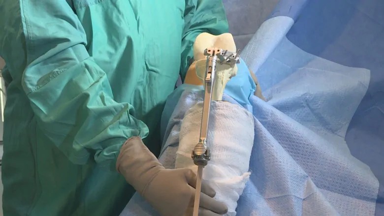 Best knee replacement surgeon in delhi